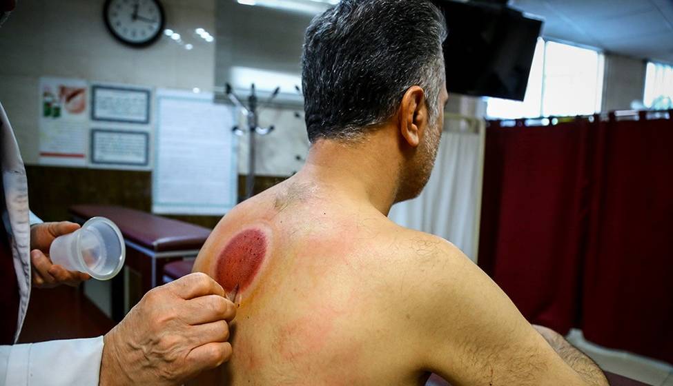 وزارت بهداشت: حجامت، فصد خون و جا انداختن استخوان در عطاری ها ممنوع است